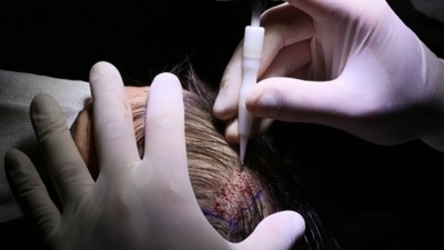 Benefits Of Fue Hair Transplant In Islamabad Royalhairtransplant Pk