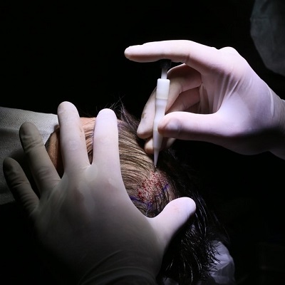5 benefits of FUE Hair Transplant