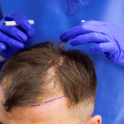 Hair Implants for Men in Islamabad