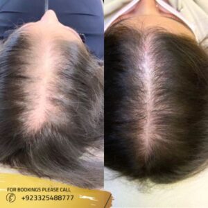 PRP Hair Treatment Before after results