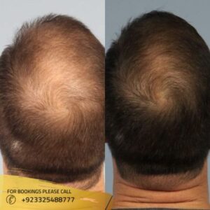 PRP Hair Treatment in Pakistan - RHT
