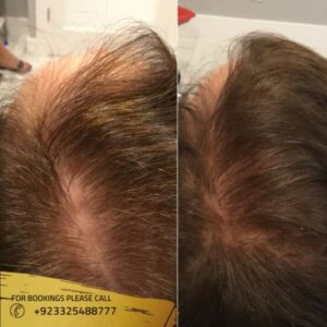 PRP Hair treatment results