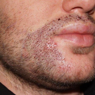 Beard hair transplant In Islamabad