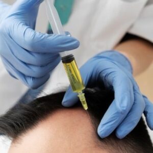 PRP hair treatment for baldness in Islamabad