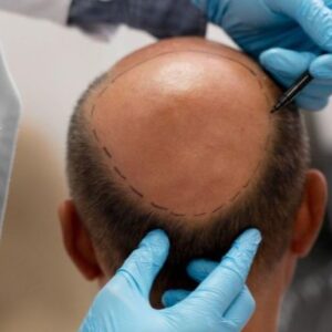 Top Reasons to Consider FUE Hair Transplant for Hair Loss