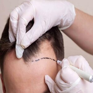 FUE Hair Transplant Side Effects and How to Manage Them