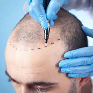 How Long Does It Take to Recover from an FUE Hair Transplant