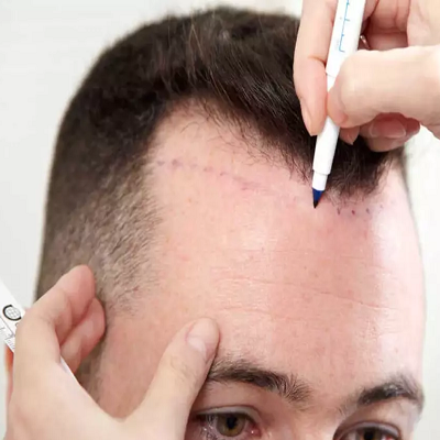 How Painful Is an FUE Hair Transplant Procedure