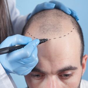 PRP Hair Treatment