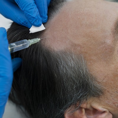 What is a Scarless Hair Transplant