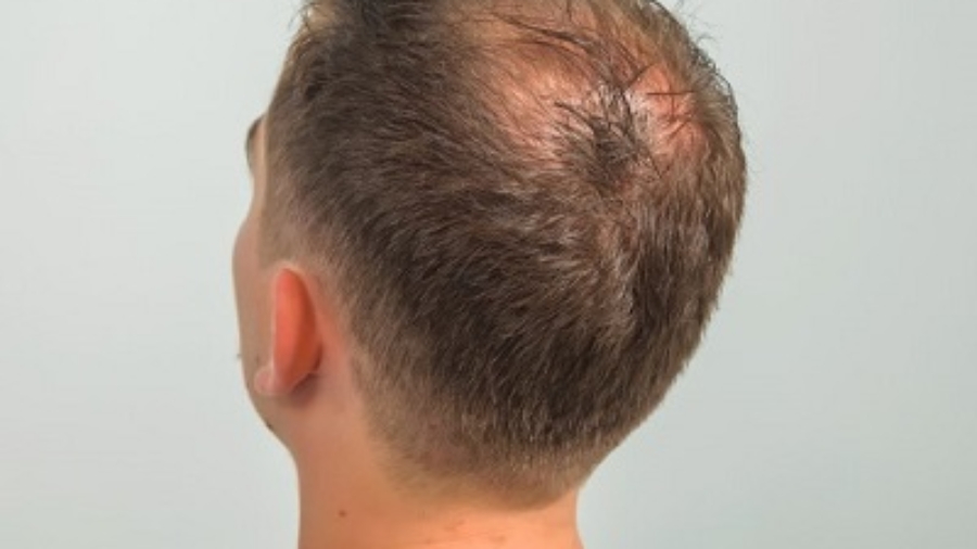 Advantages and Cost of Hair Transplant