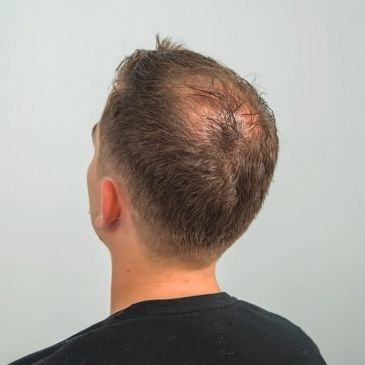 Advantages and Cost of Hair Transplant