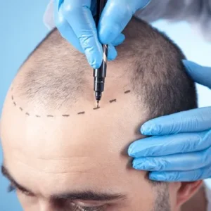 Factors To Consider For A Hair Loss Treatment in Islamabad