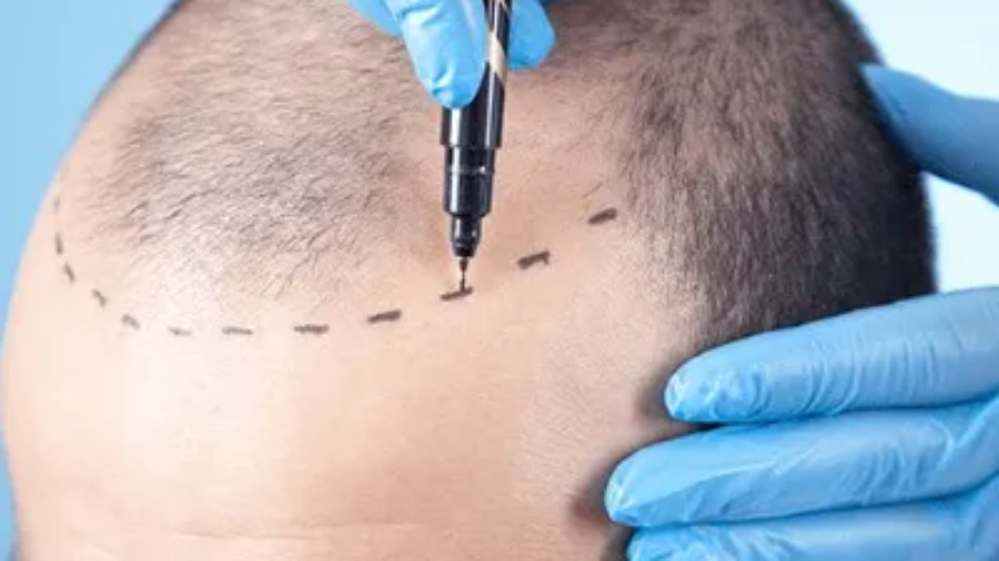 Factors To Consider For A Hair Loss Treatment in Islamabad