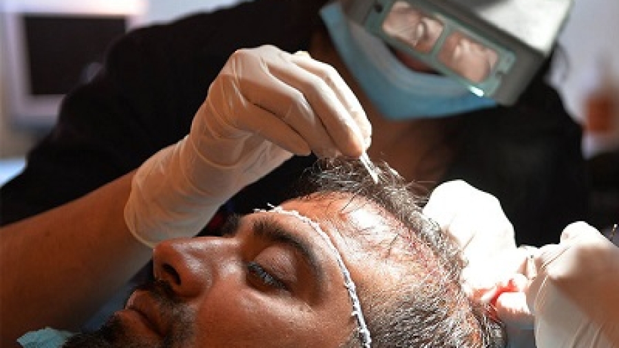 Hair Transplant Price in Islamabad