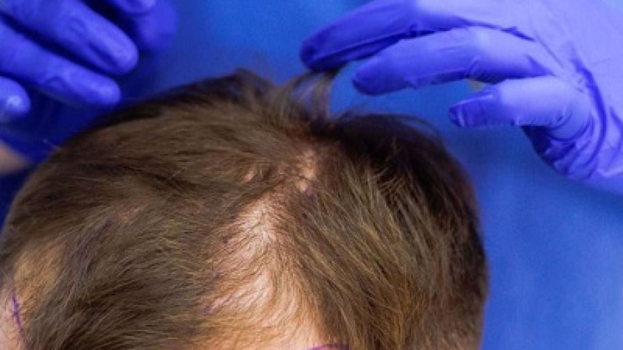 Hair Implants for Men in Islamabad