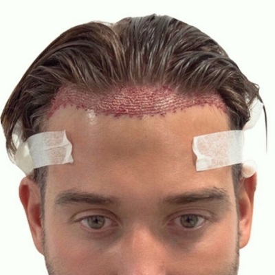 Can I Go Out in the Sun After My Hair Transplant?