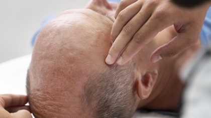 How Does Hair Restoration Work