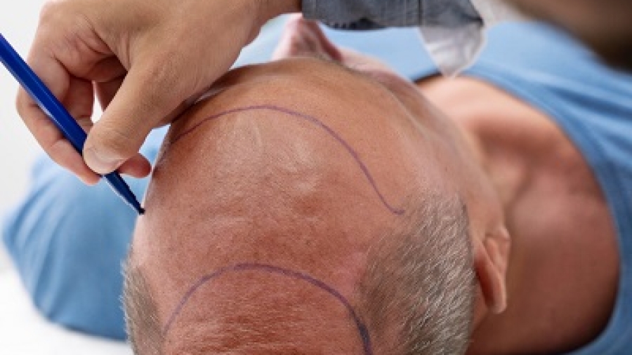 What Should I Do If I Accidentally Touch My Hair Grafts