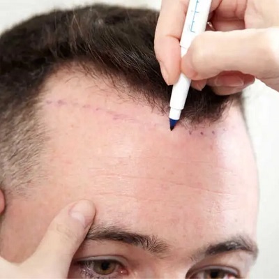 Cutting Edge Method in FUE Hair Transplant