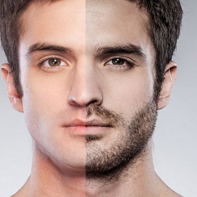Beard Hair Restoration Services in Islamabad You Can Trust