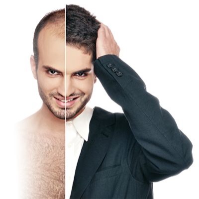 Best Hair Restoration Techniques in Islamabad What You Need to Know