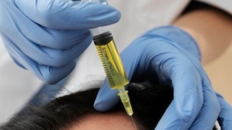 PRP hair treatment for baldness in Islamabad