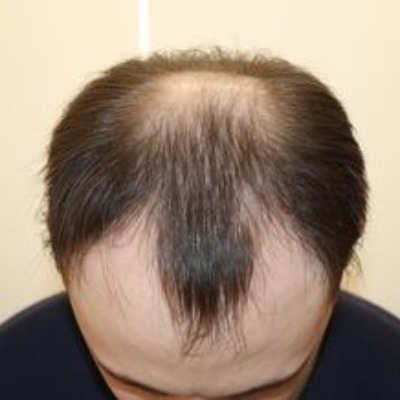 What Makes Hair Transplant in Islamabad a Popular Choice