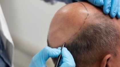 What to Expect Before, During, and After Your Hair Transplant in Islamabad