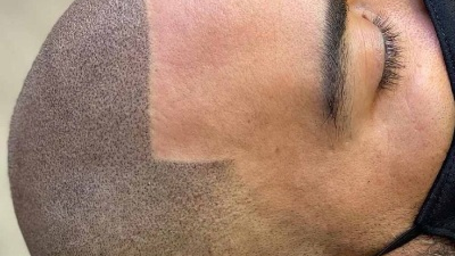  Does a Person’s Blood Type Impact Hair Restoration Success