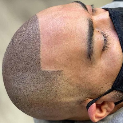 Does a Person’s Blood Type Impact Hair Restoration Success