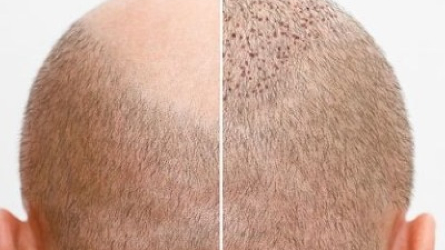 How Many Grafts Do I Need for a FUE Hair Transplant?