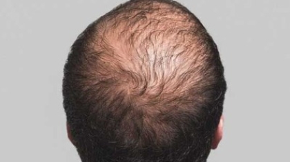 What Are the Latest Advancements in Hair Restoration?