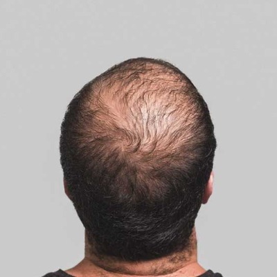 What Are the Latest Advancements in Hair Restoration?