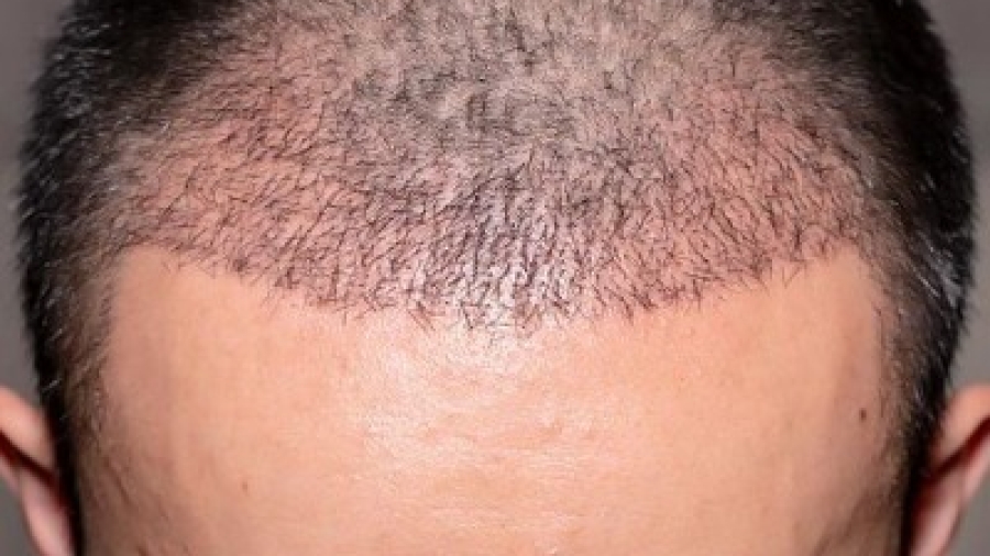 What Makes FUE Hair Transplant Different from FUT