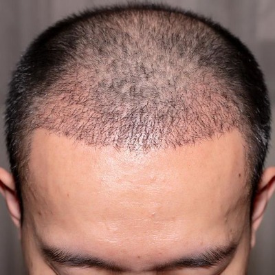 What Makes FUE Hair Transplant Different from FUT