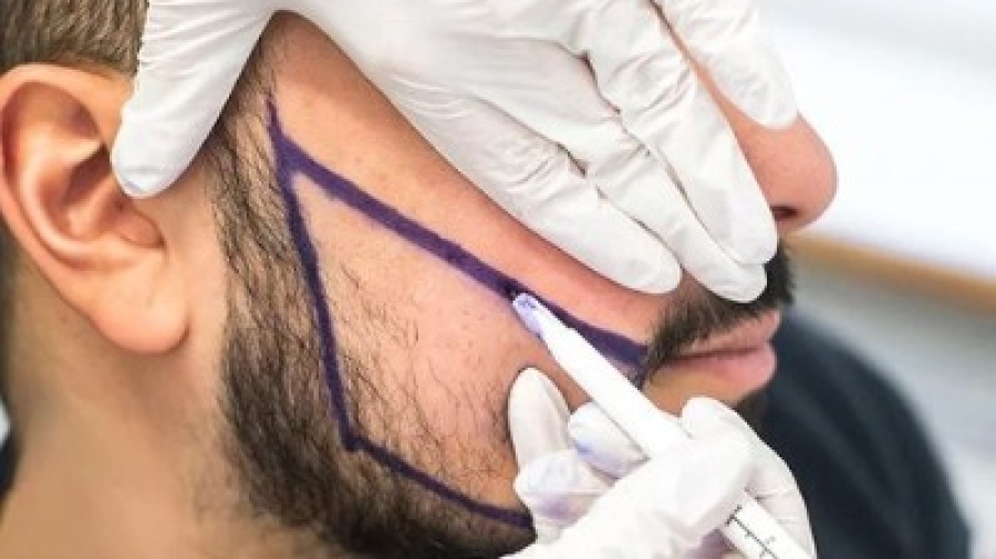 Your Path to a Masculine Look: Beard Transplant in Islamabad
