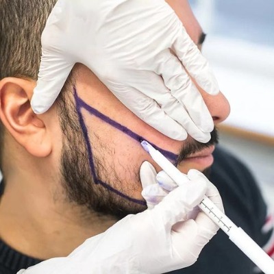 Your Path to a Masculine Look: Beard Transplant in Islamabad