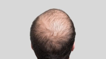 Can a Hair Transplant Restore Hair on Scars or Damaged Areas