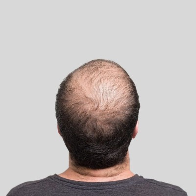 Can a Hair Transplant Restore Hair on Scars or Damaged Areas