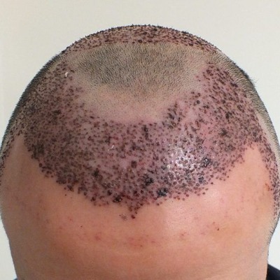 Hair Transplant in Islamabad Meet the Experts Changing Lives