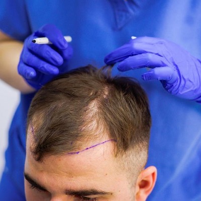 How Do Doctors in Islamabad Handle Complications in Hair Transplant Surgeries