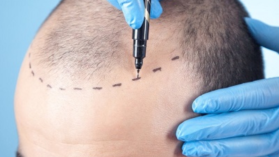 How Long Does It Take to Recover from an FUE Hair Transplant
