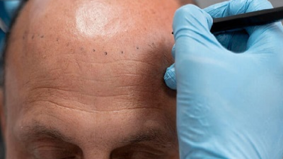 Losing Hair Fast? Discover the Solution That Works!