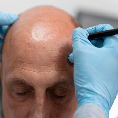 Losing Hair Fast? Discover the Solution That Works!