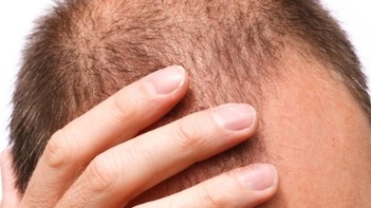 What Are the Latest Hair Restoration Options Available in Islamabad?