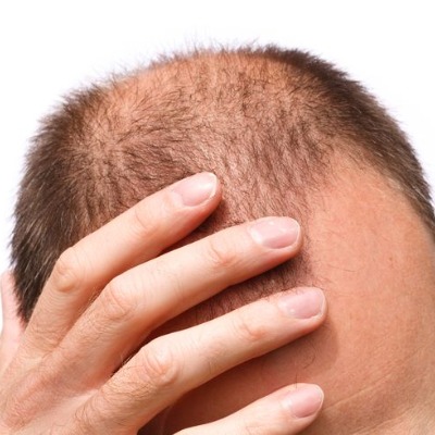 What Are the Latest Hair Restoration Options Available in Islamabad?
