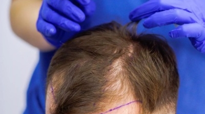 Are Non-Surgical Hair Solutions Effective