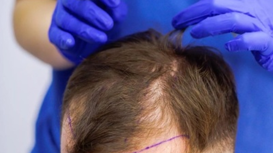 Are Non-Surgical Hair Solutions Effective