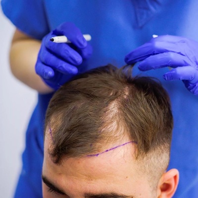 Are Non-Surgical Hair Solutions Effective